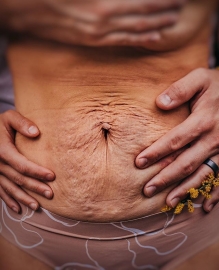 Как убрать живот и расстяжки после родов